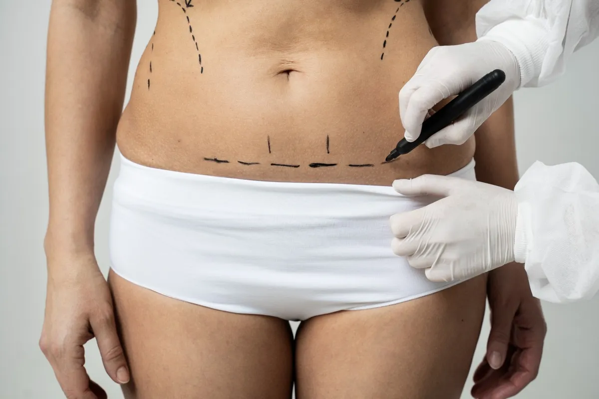 What Is Monsplasty? Benefits, Procedure and Recovery Guide