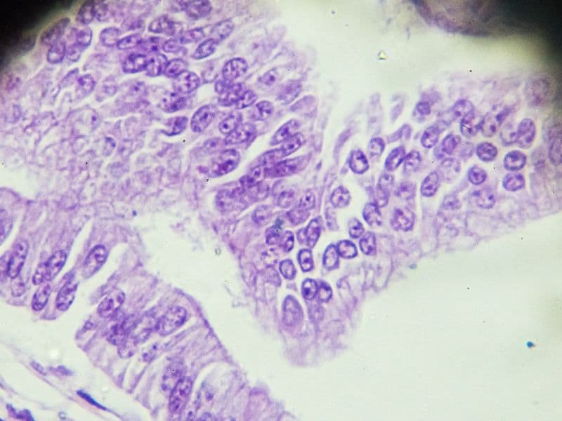 Adenomyosis consultation