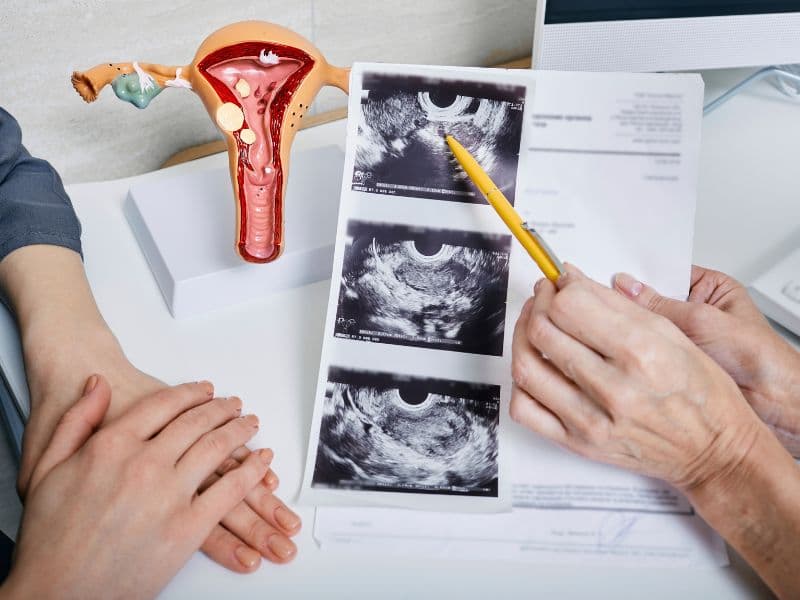 PCOS