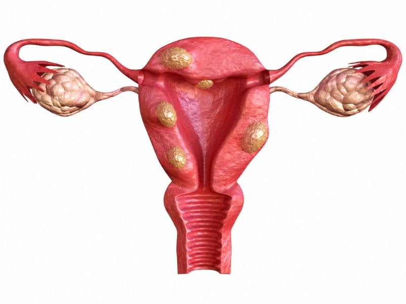 Uterine fibroids consultation