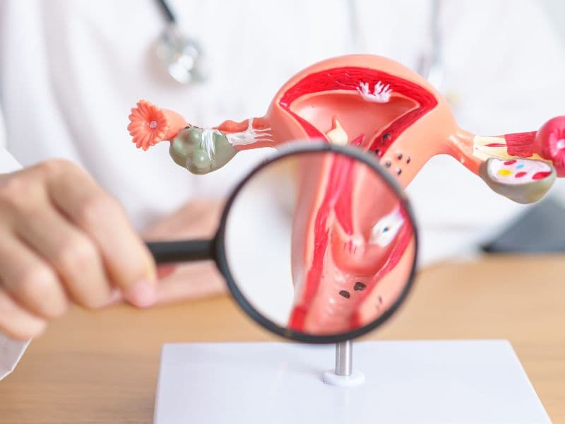 Uterine Fibroids