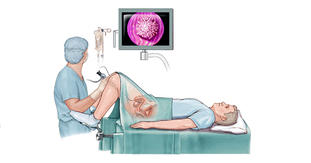 How Does the Cystoscopy Procedure Done?