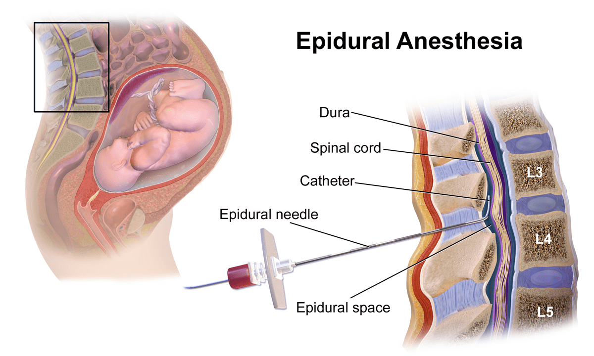 What is Epidural Anaesthesia?