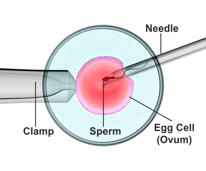 Intracytoplasmic Sperm Injection - ICSI