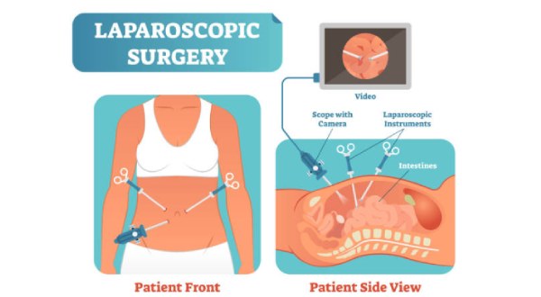 Why Choose Laparoscopic Surgery Purpose, Types & Benefits