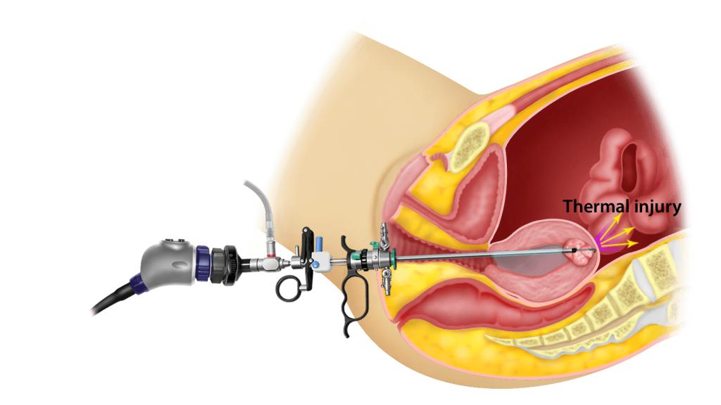  Hysteroscopy Surgery