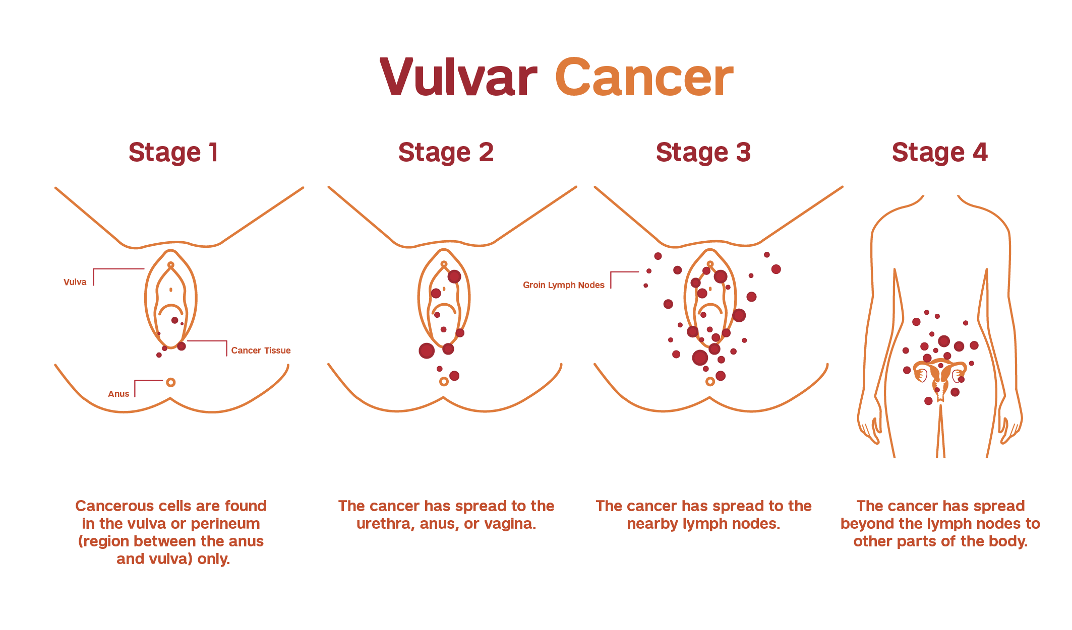 Stages of Vulvar cancer