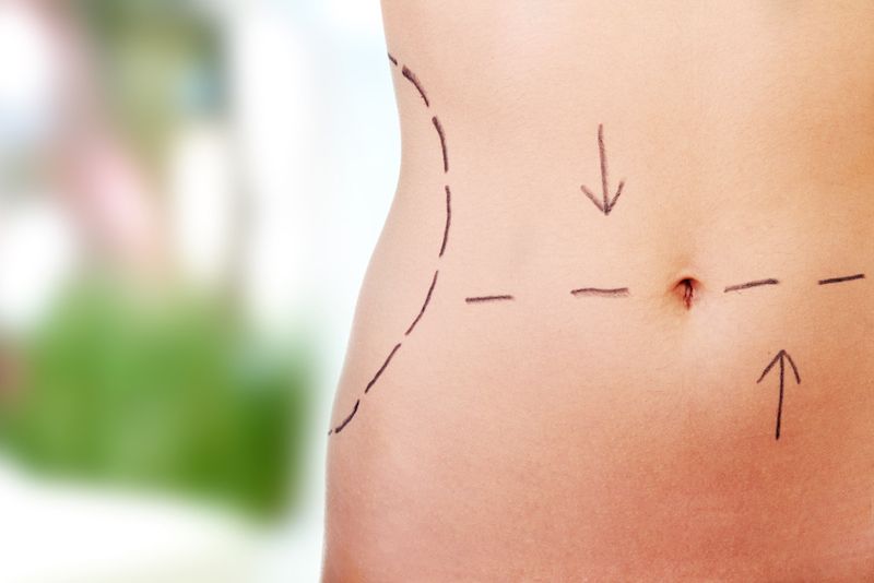 RISKS ASSOCIATED WITH TUMMY TUCK SURGERY